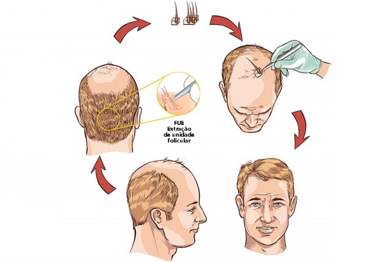 Implante Capilar Fue Tratamento Capilar Porto Alegre